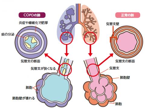 COPDの肺